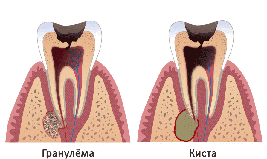 гранулема и киста